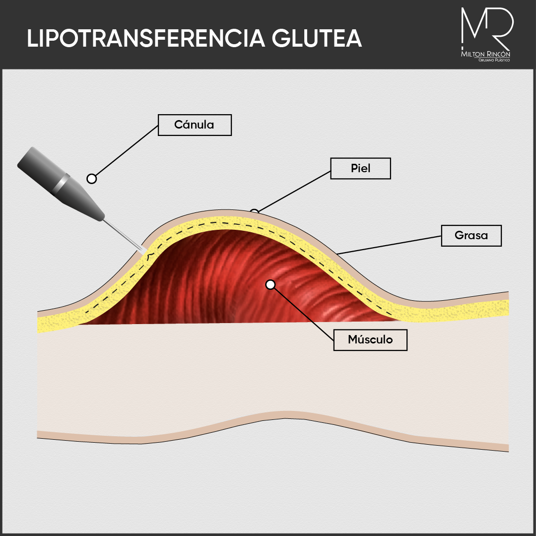 Evolución de abdominoplastia